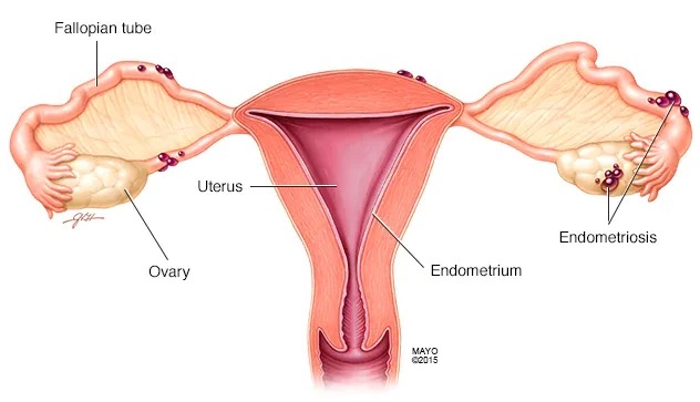 Endometriosis