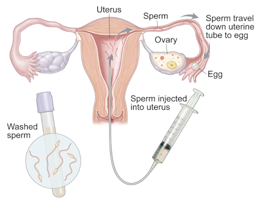 IUI Treatment
